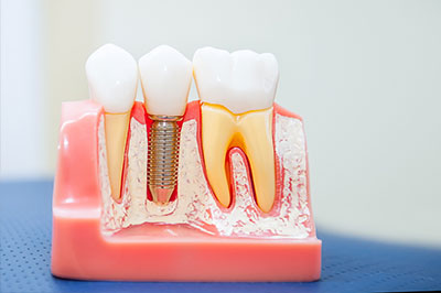 Dr. Philip Leta & Dr. Damian Jones | Dentures, Veneers and Oral Exams